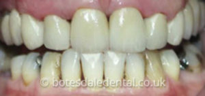 dental-bridge-after