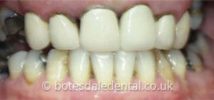 dental bridge - before